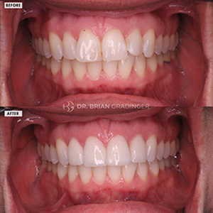 Dental Crowns Before After Results - Brian Gradinger DMD, Case-4