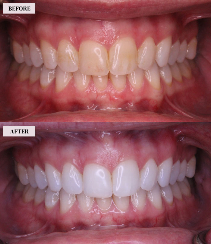 Routine Cleaning and Bleaching - Brian Gradinger DMD