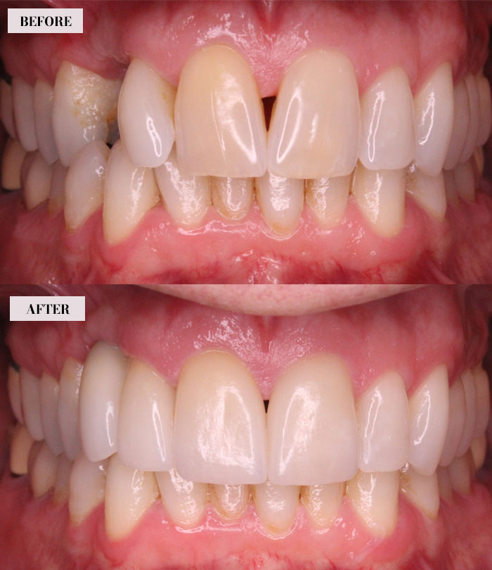 3 Veneers and 1 Dental Implant Crown - Brian Gradinger DMD