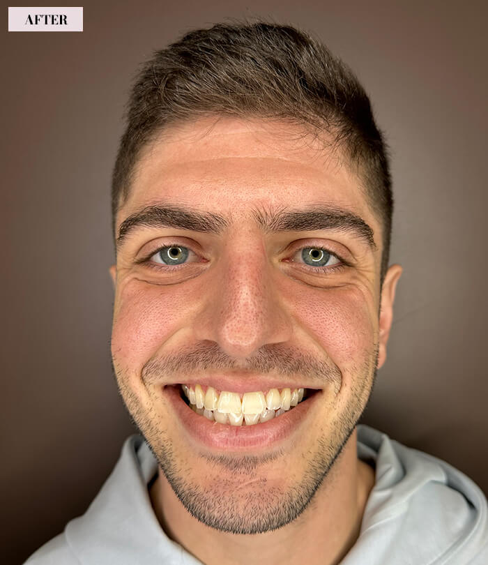 Dental Bonding Before After Results - Case-1, After Full face image, Brian Gradinger DMD