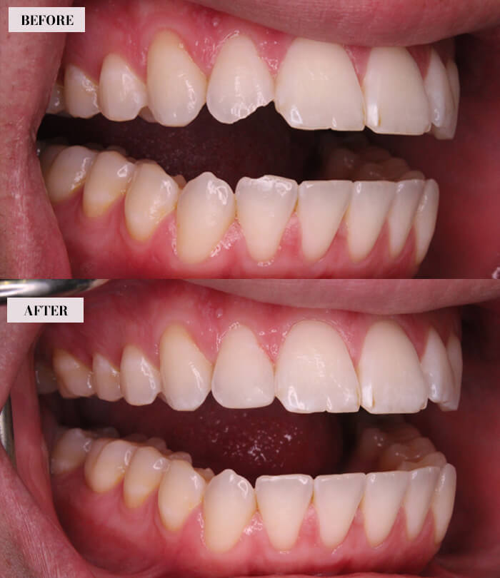 Dental Bonding Before After Results - Case-1, Image-2, Brian Gradinger DMD