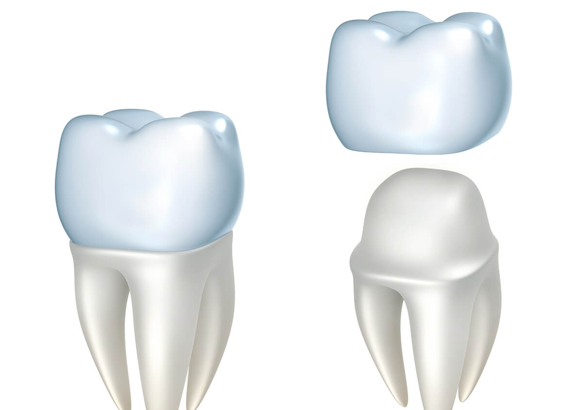 Crowns for Your Teeth in Valencia CA Area