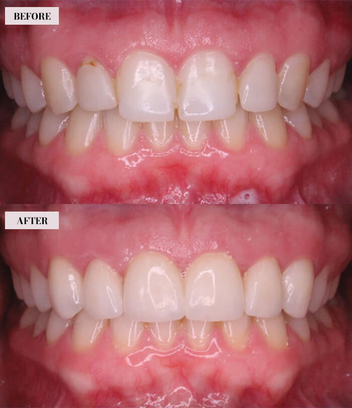 2 Dental Veneers - Before & After Images-2 - Brian Gradinger DMD