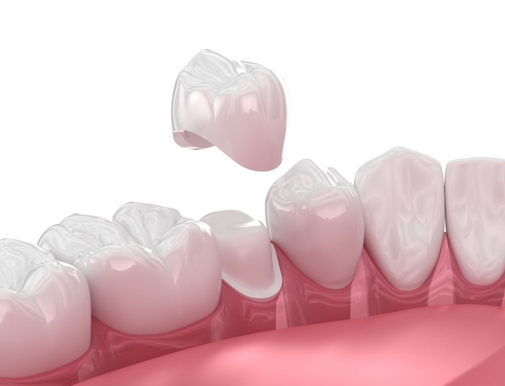 dental crowns in valencia