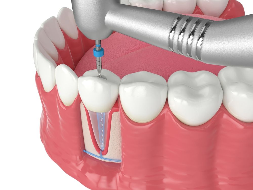 root canal therapy in valencia