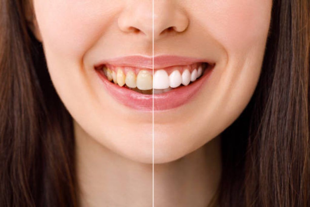 why your teeth aren’t whitening