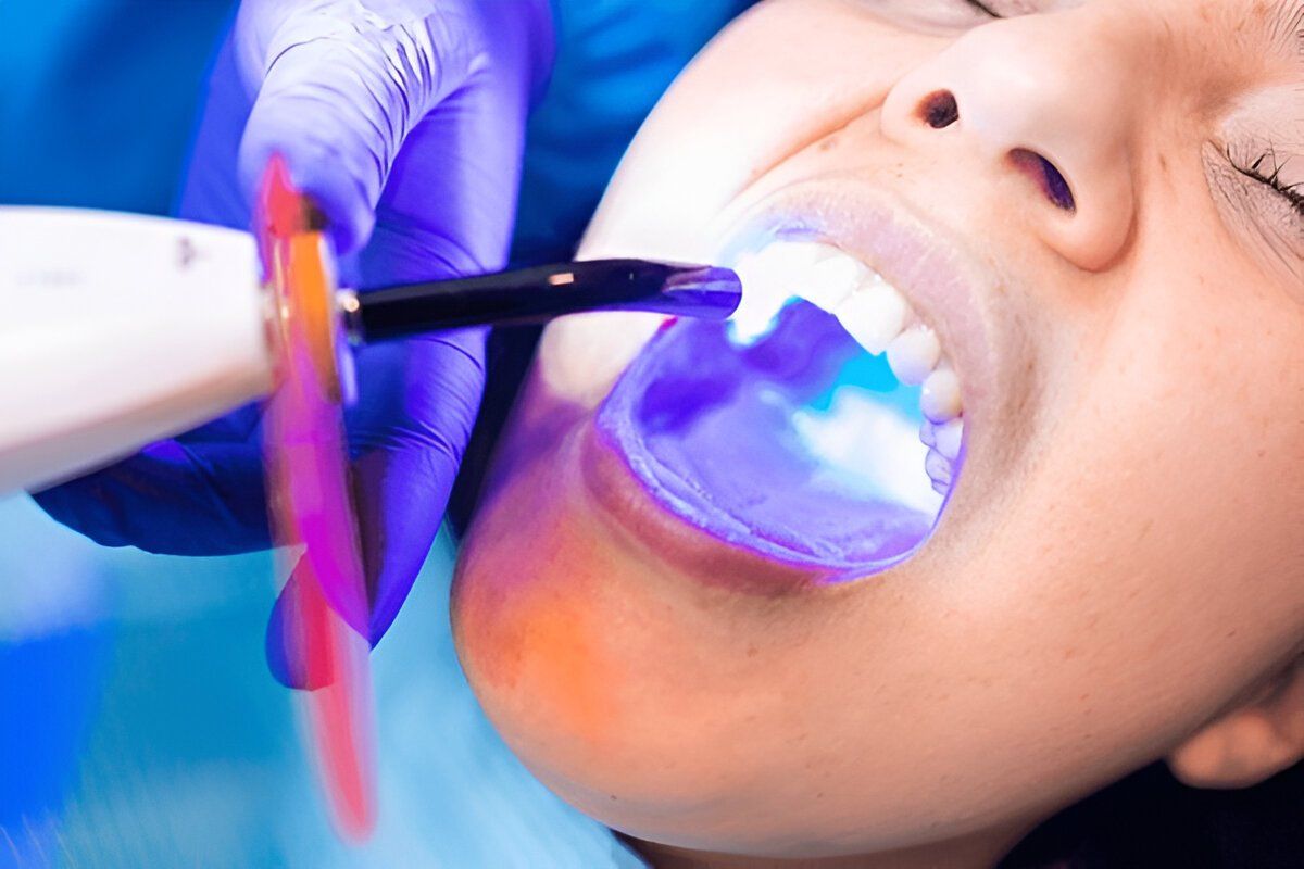 composite fillings near you