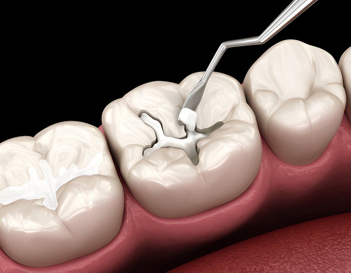 composite fillings valencia ca