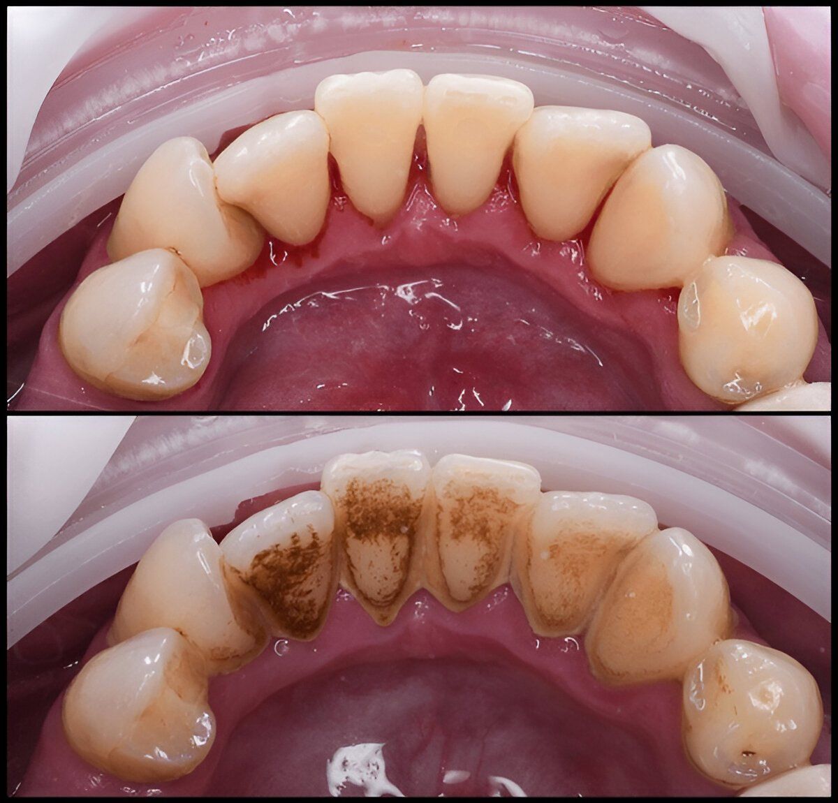 deep dental cleaning near you