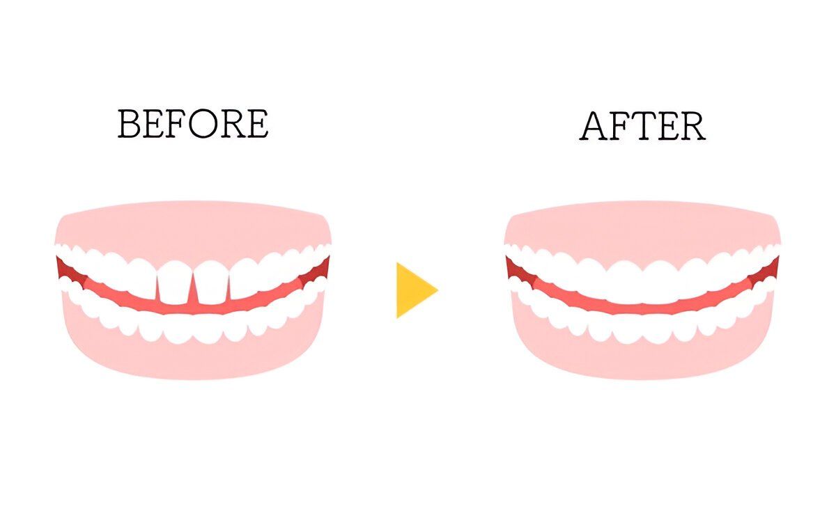 dental bonding in valencia ca