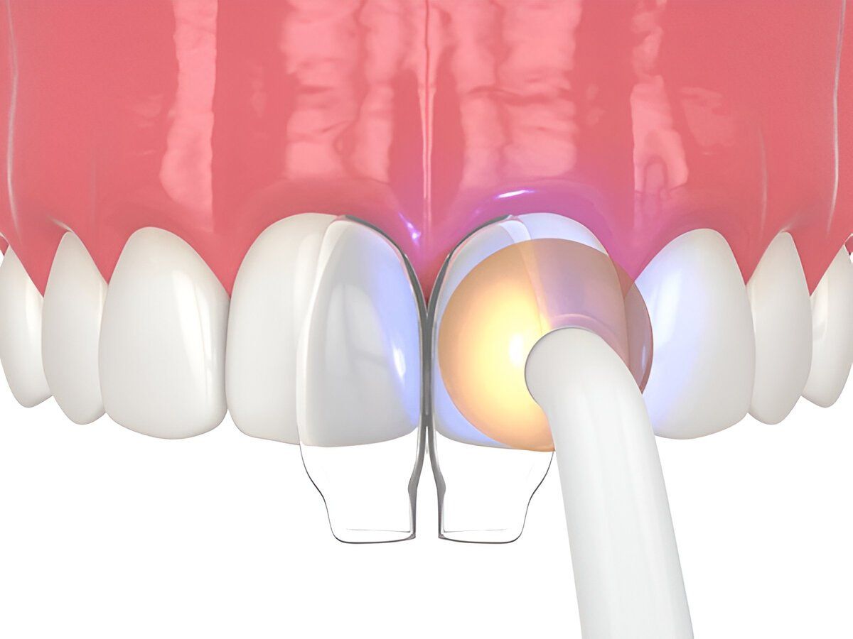 dental bonding near you