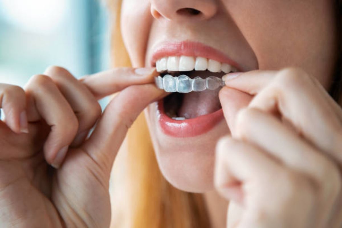 how to track clear aligner progress
