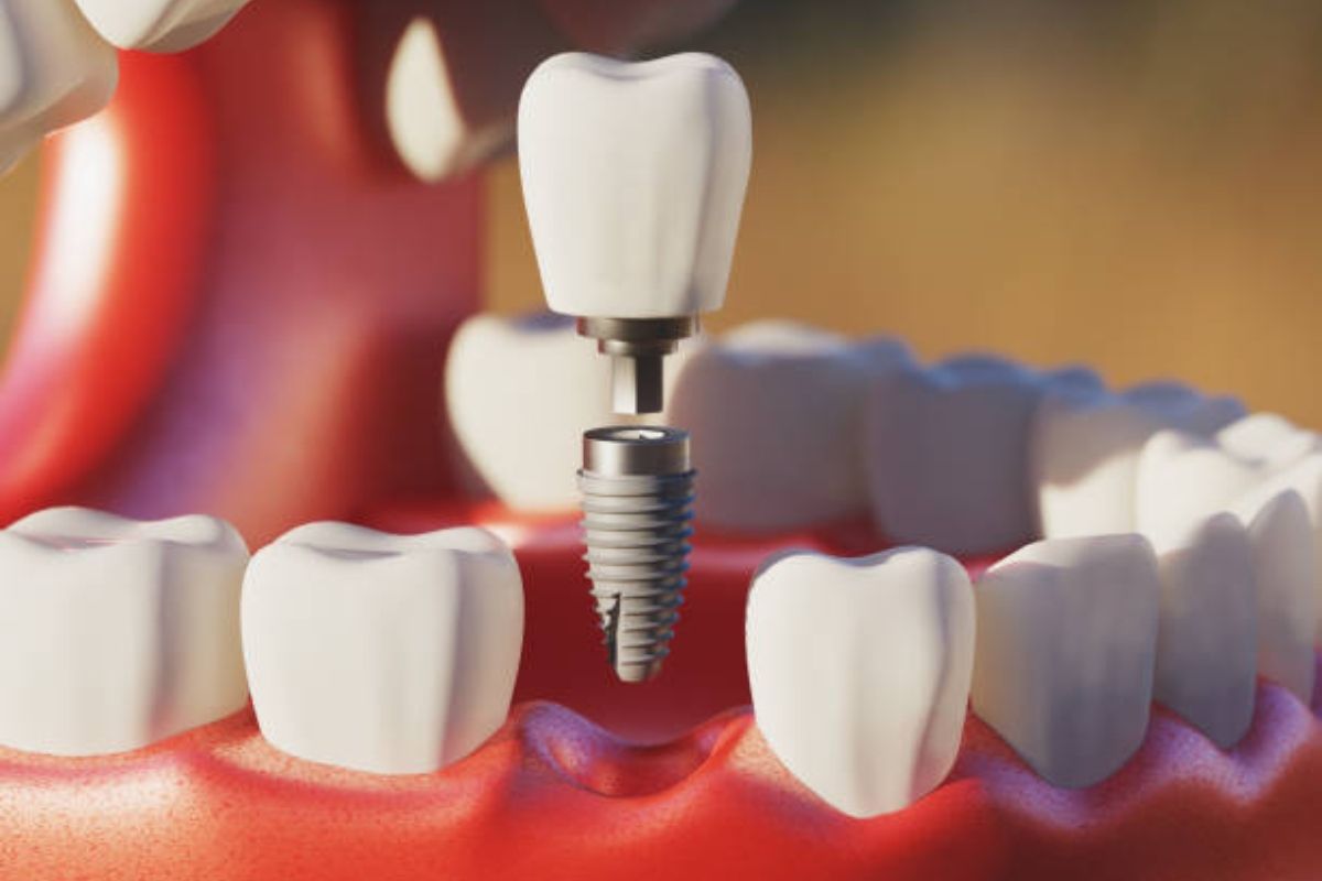 what to avoid after implant surgery