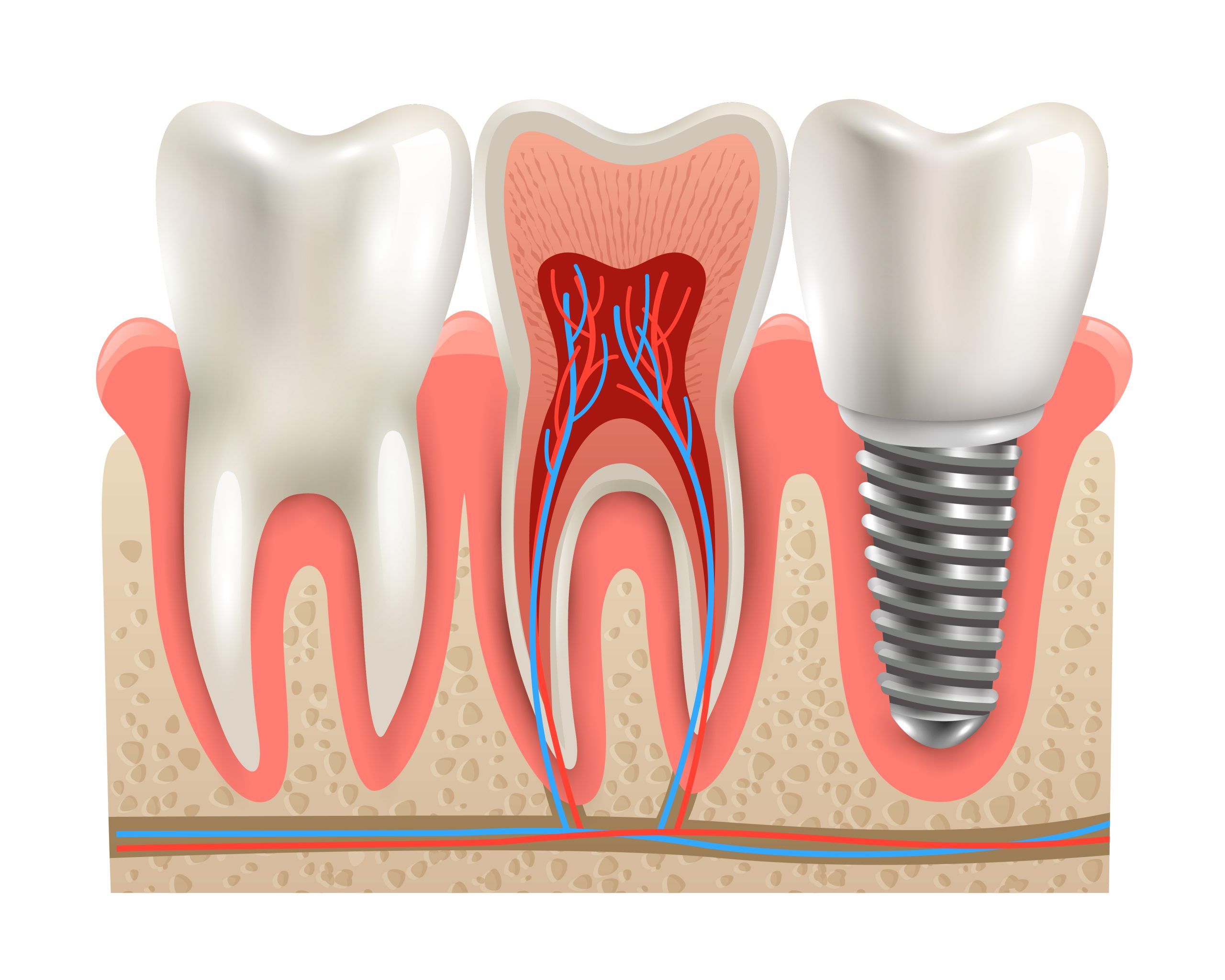 dental-implants-risk-and-prevantion