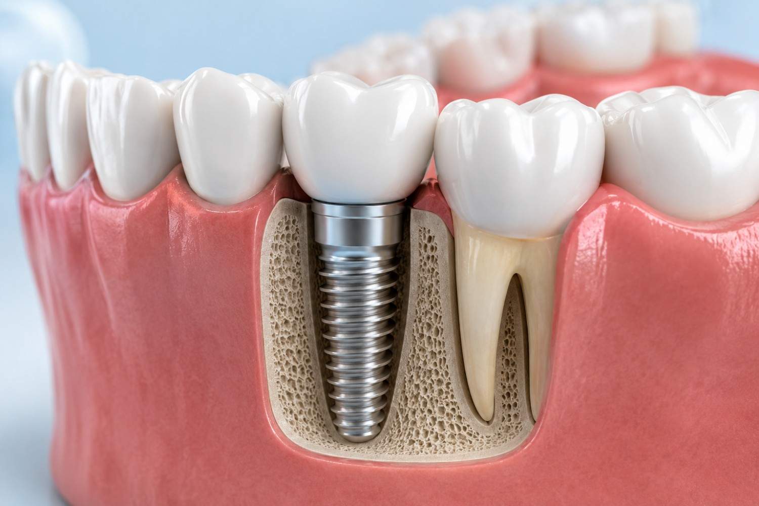 Will implants last forever long term patient wins